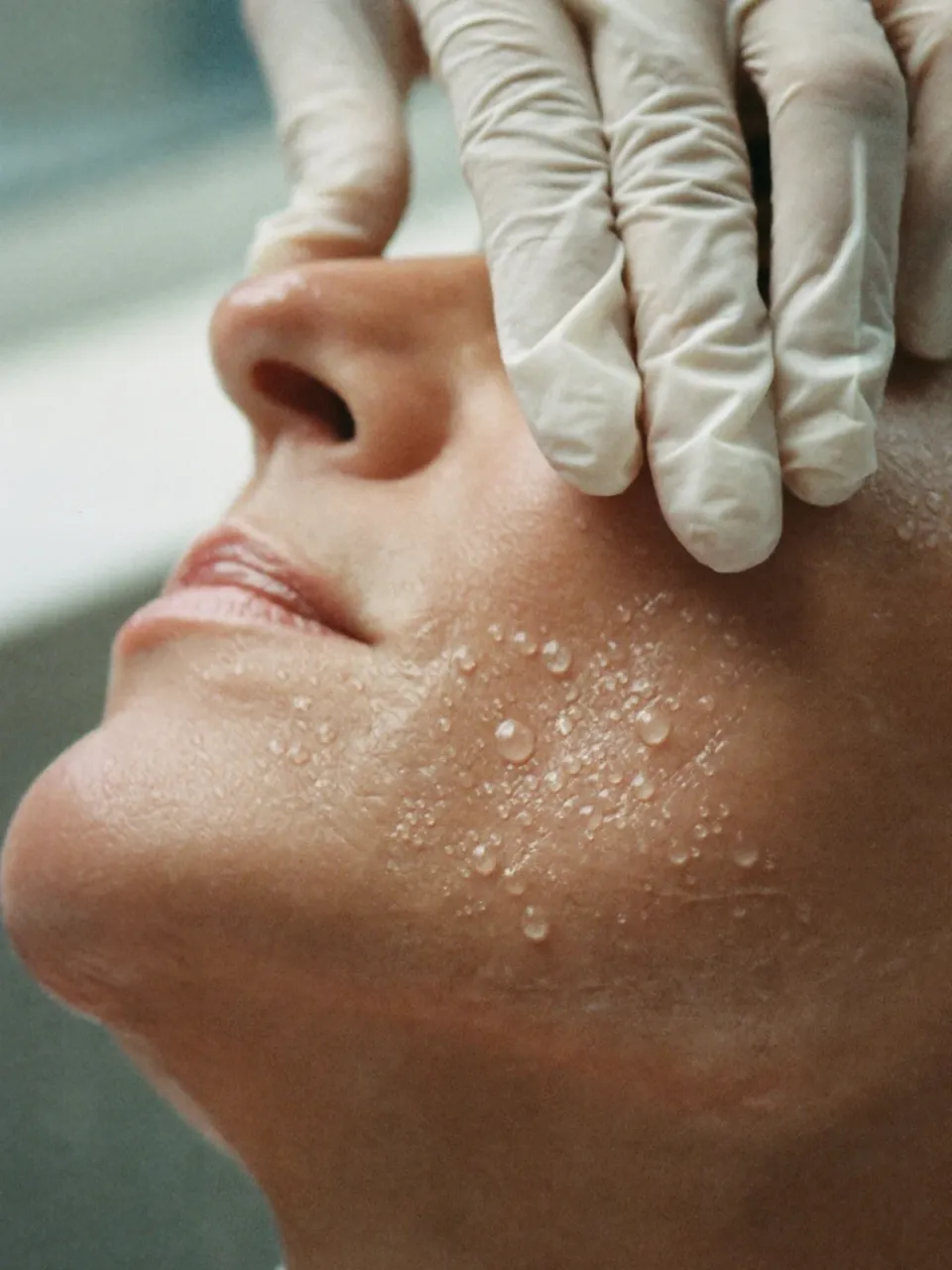 SkinBooster de Ácido Hialurónico · edel.Clinic